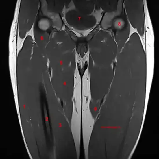 MRI Right Thigh With Contrast